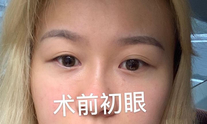 看完再决定要不要入坑,怎样判断需不需要开外眼角