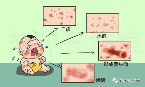 宝宝湿疹反复该怎么护理,母婴身体长湿疹