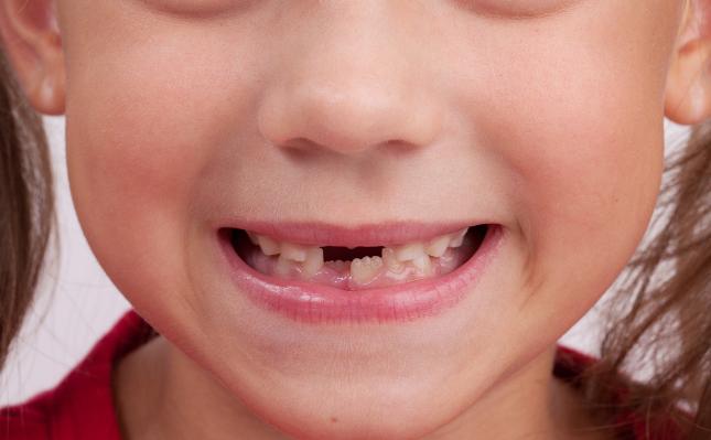 提醒家长关注幼儿换牙问题,换牙期父母要知道的