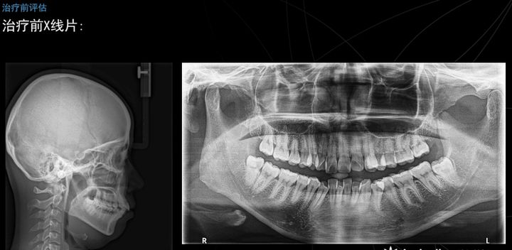 西安透明式牙齿矫正器龅牙,昆明牙齿矫正改变脸型