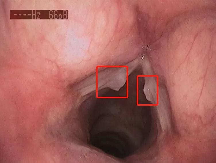 咽喉部痛声音哑时间长了是不是癌,咽喉息肉唱歌会嘶哑