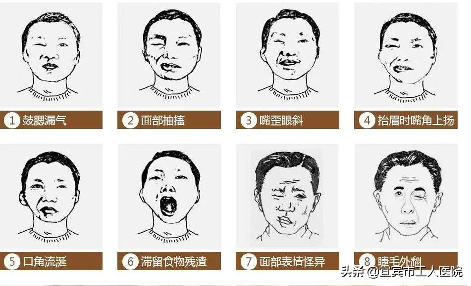 宜宾中医院治疗面瘫,宜宾哪家医院治疗面瘫最好