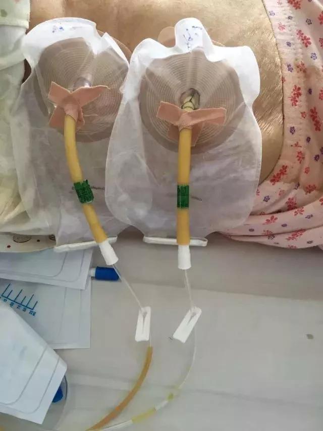 引流伤口有渗液流出怎样处理,术后20天引流液还很多怎么办