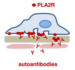 膜性肾病流行病学,膜性肾病的最新研究