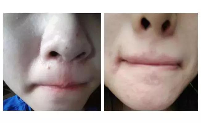 熬夜追《知否》后脸上狂暴痘？这些德国产品可以拯救你的脸！