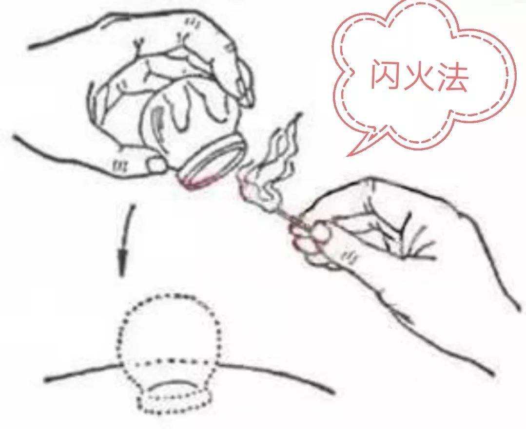 拔罐竟然把自己门牙弄断，基本操作要弄清楚