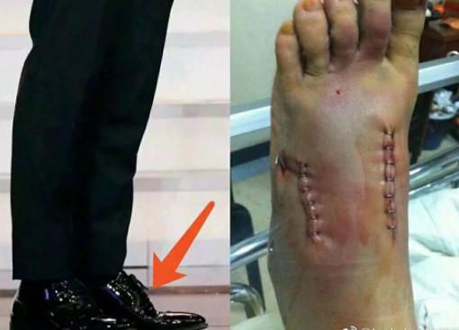 黄晓明穿增高鞋视频,黄晓明内增高现场