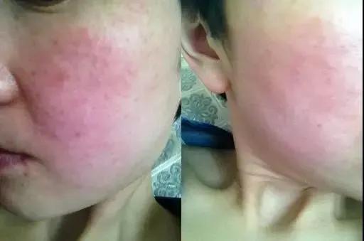 戴口罩长痘了有什么办法可以消除,戴口罩长痘痘怎么快消除