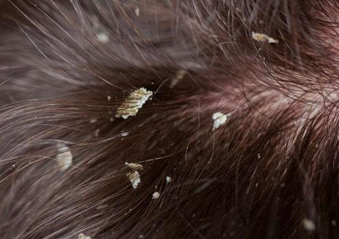 梦禾科普｜如何对付烦人的头皮屑