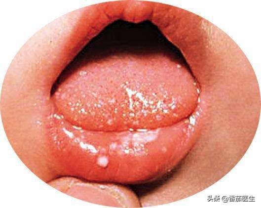 感染乙肝病毒就是有肝炎吗,慢乙肝怎样调理