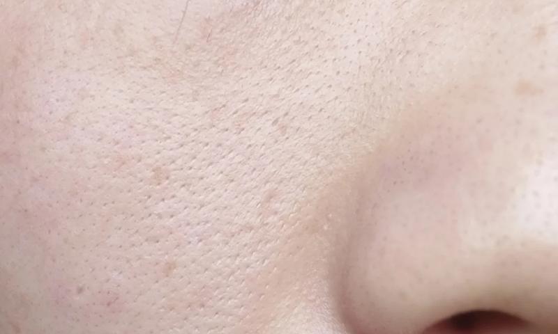 毛孔堵塞的原因,腿上汗毛堵塞在毛孔里是什么原因