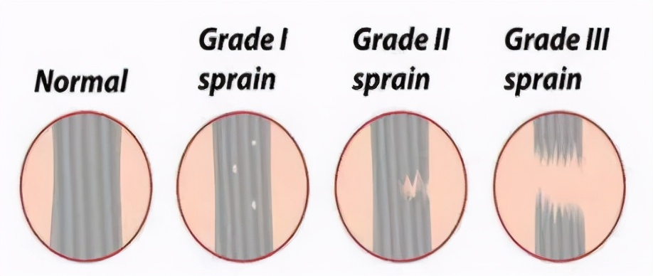 跟腱断裂康复论文,跟腱康复纪录片