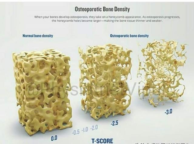 老年人骨质疏松严重造成腰骨折,髋部骨折包括哪些骨折