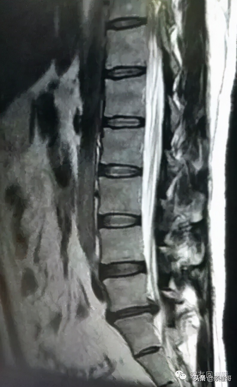 腰突椎间孔镜手术后复发怎么办,腰突做椎间孔镜手术到底好不好