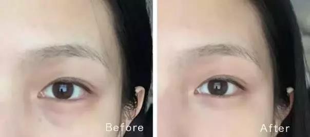 眼睛黑眼圈显老怎么办,眼睛黑眼圈大眼袋怎么消除