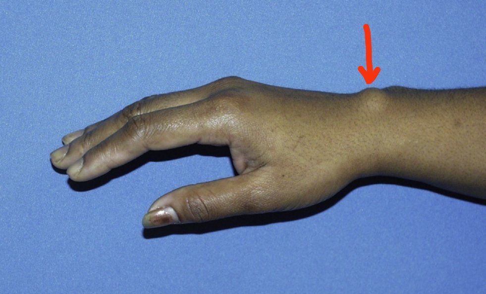 骨科医生手腕囊肿,骨科医生能看腱鞘囊肿吗