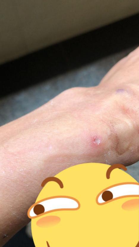 治好多年痔疮的经历,痔疮的真实案例