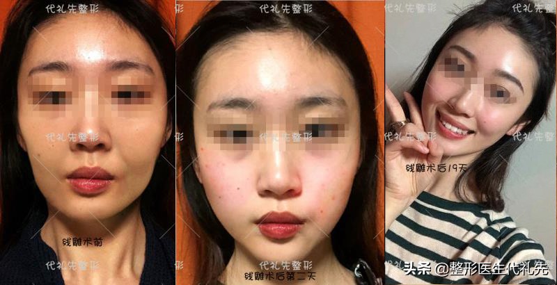 从整形医生的角度来聊一聊形成法令纹的原因以及改善方案