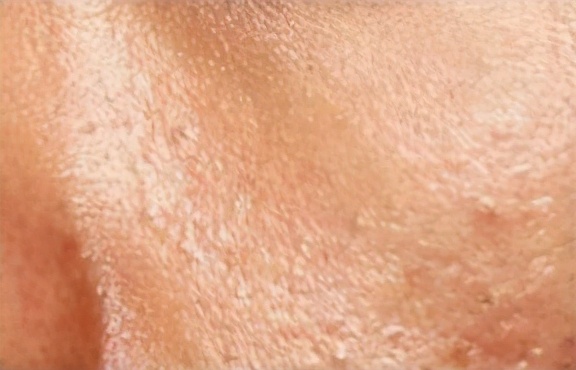 皮肤粗糙毛孔粗大最快的解决办法,皮肤松弛毛孔粗大黑头多怎么解决