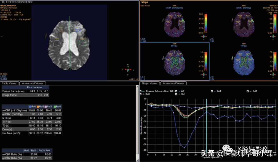飞利浦磁共振脑灌注怎么测量,飞利浦核磁诊断教学