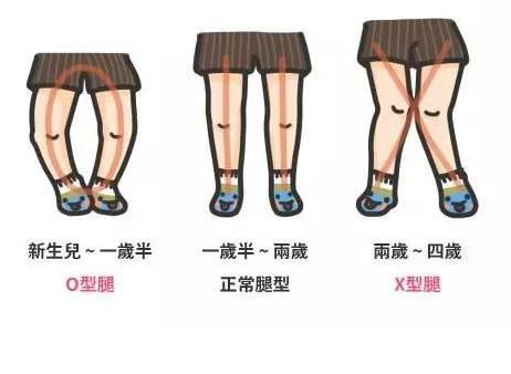 宝宝穿错鞋，骨骼变形？O型腿？选错鞋影响宝宝一生（如何选鞋）