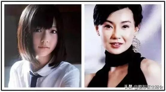 颧骨磨骨苹果肌下垂如何修复,如何判断是苹果肌还是高颧骨