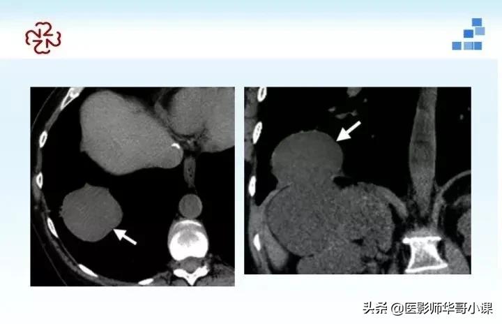 「精品课件」胸部膈肌的解剖及常见病变影像的表现