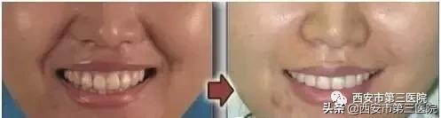 肉毒素能美白皮肤吗,肉毒素在医学美容的作用