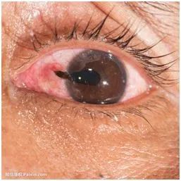 让孩子远离眼外伤的方法,儿童眼外伤