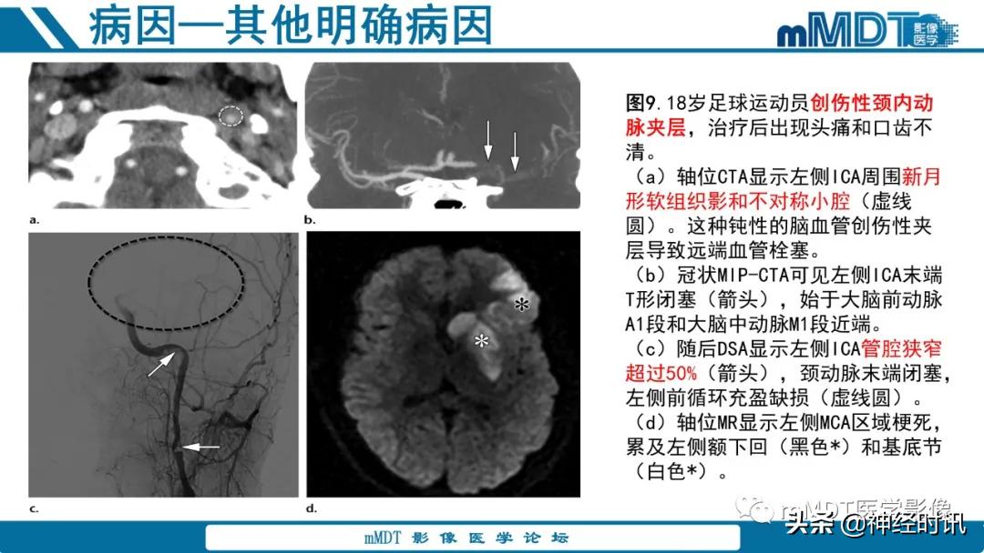 急性缺血性脑卒中ppt素材图片,青年缺血性脑卒中ppt