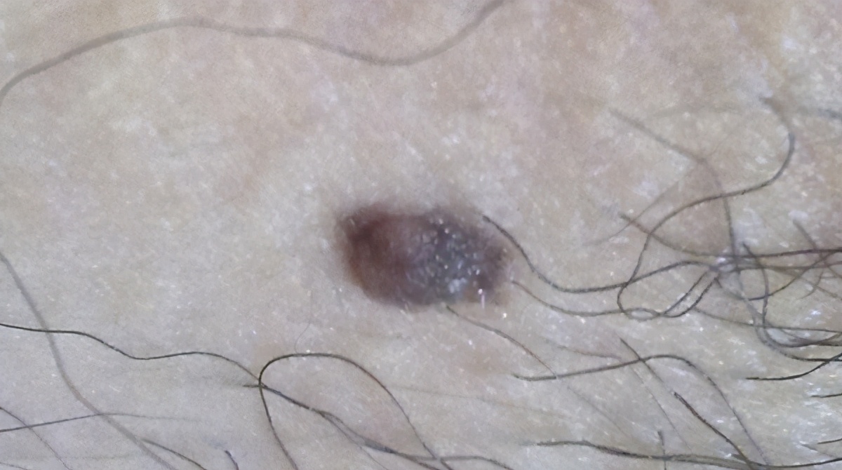 手术中的病理检查准确率高吗,手术病理