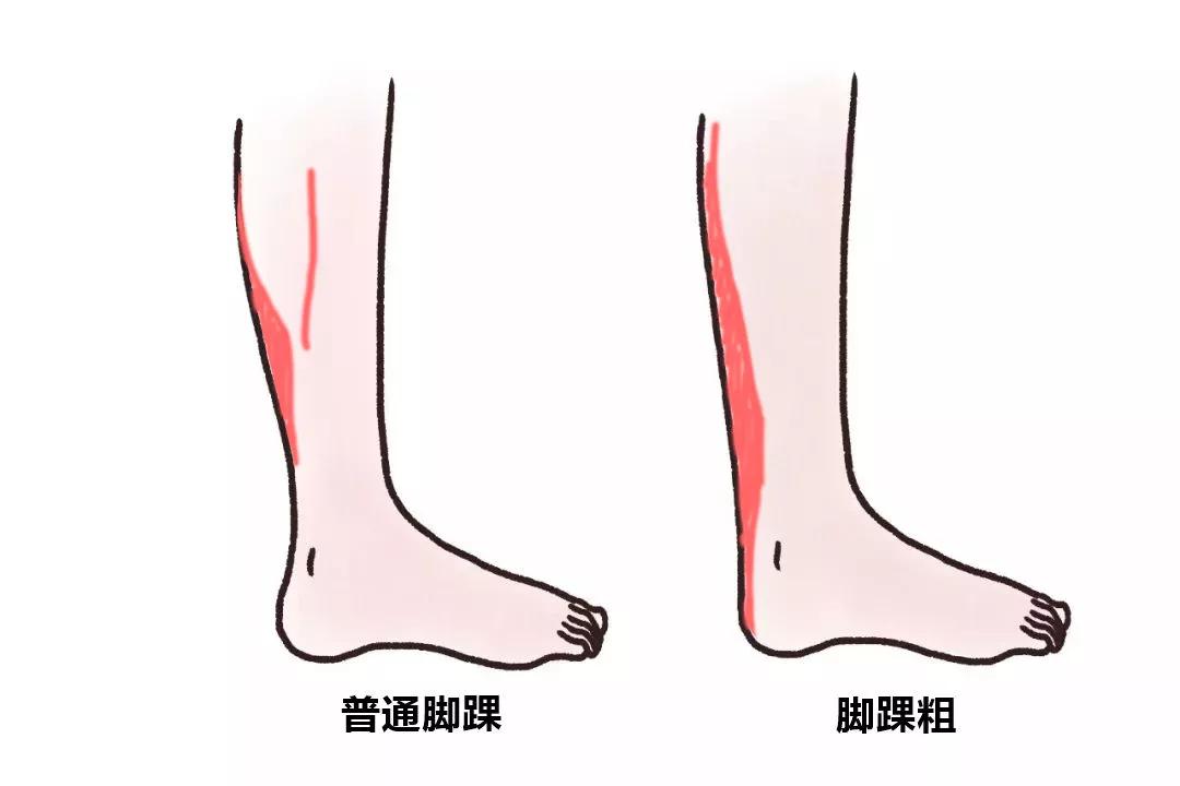 小短腿腿粗怎么改善,腿粗脚踝粗脂肪腿怎么办