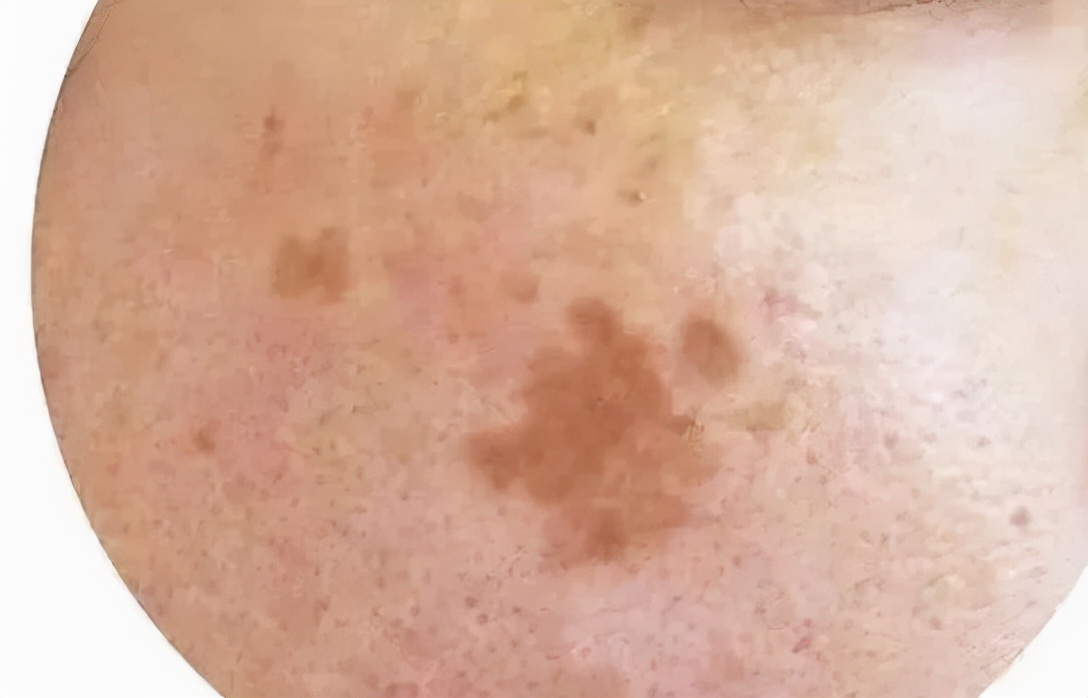 一招教你彻底祛斑,轻松祛斑先养肝