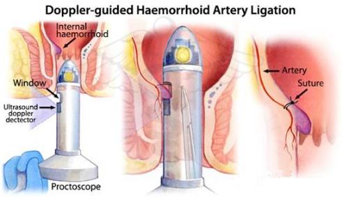 得了菊花痣怎么办,菊花残满地伤