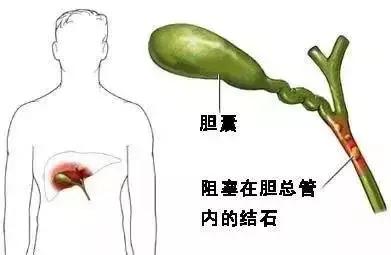 急性胆管炎会不会传染黄疸,胆囊炎和胆管炎会出现黄疸嘛