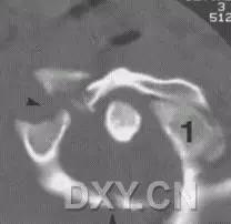 所有骨折都叫什么名字,骨折的名称有哪些