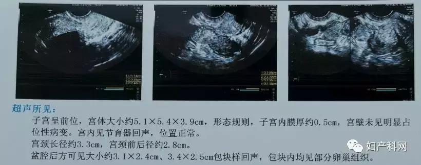 微·无创|NO.22病例分享之经阴道卵巢囊肿穿刺
