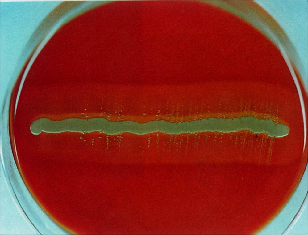 小儿李斯特菌病，常见于新生儿，以及有免疫缺陷的儿童，成人少见