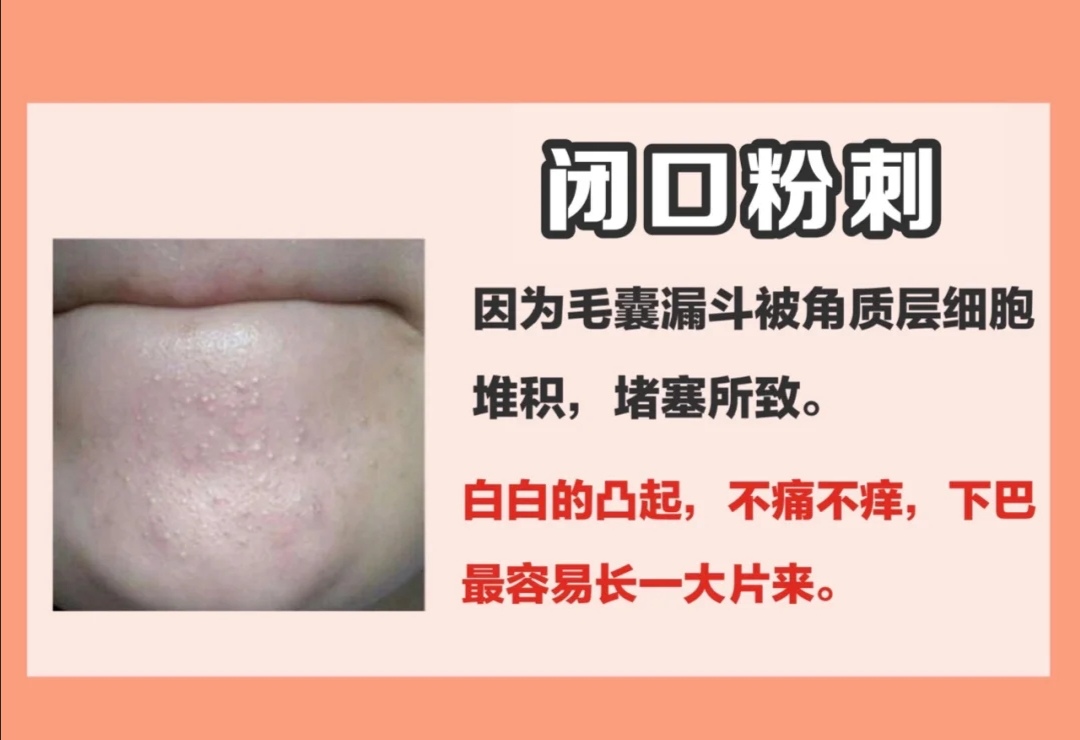 去黑头不伤皮肤的最好方法,去黑头不伤皮肤的最有效方法