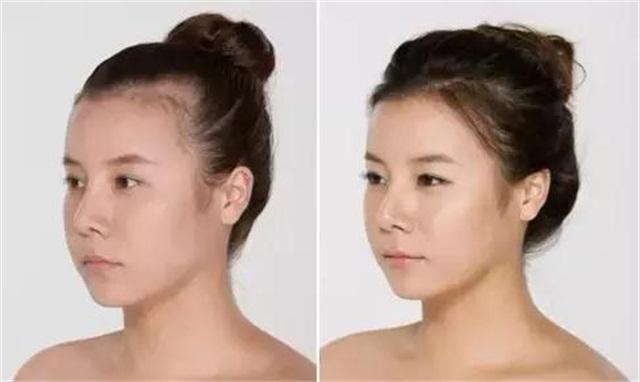 一招教你解决发际线后移,发际线秃了怎么拯救真实案例