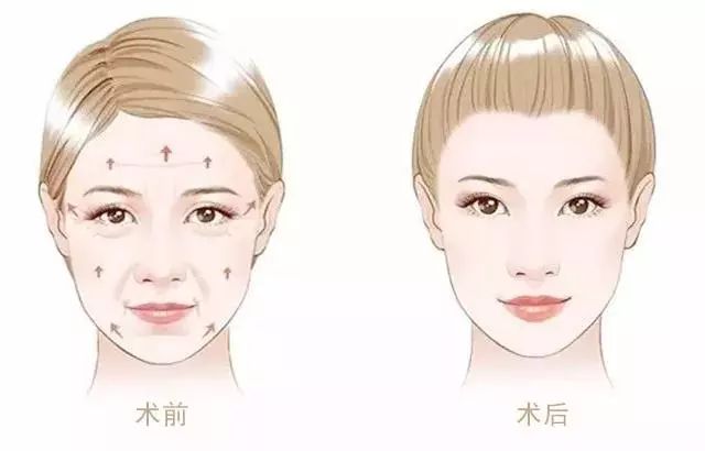 超声刀会使脸变得特饱满,超声刀能抚平皱纹吗