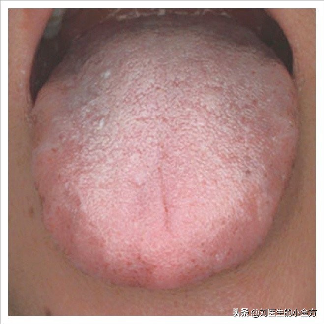 中医舌诊对照表100例,舌诊辨九大体质