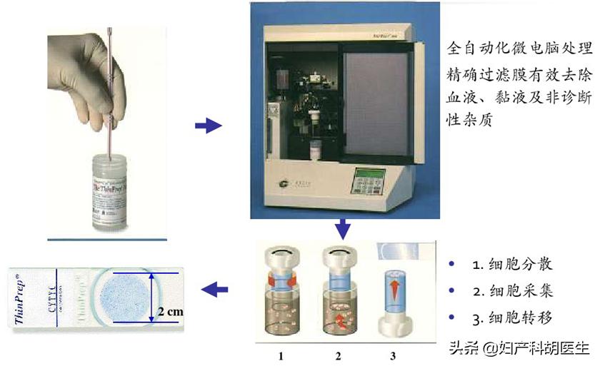 宫颈细胞学检查tct是怎样检查,如何看懂你的宫颈tct结果