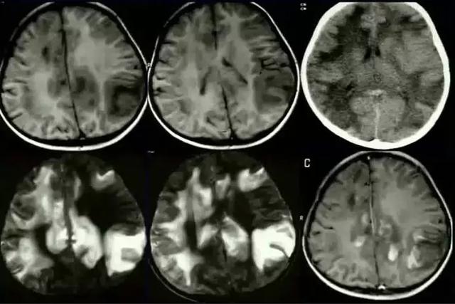 脱髓鞘病变是什么病怎么读,脱髓鞘病变的特征