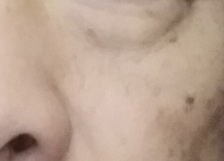 油溅到脸上有黑斑多久消失图片,脸上有老年黑斑怎么治