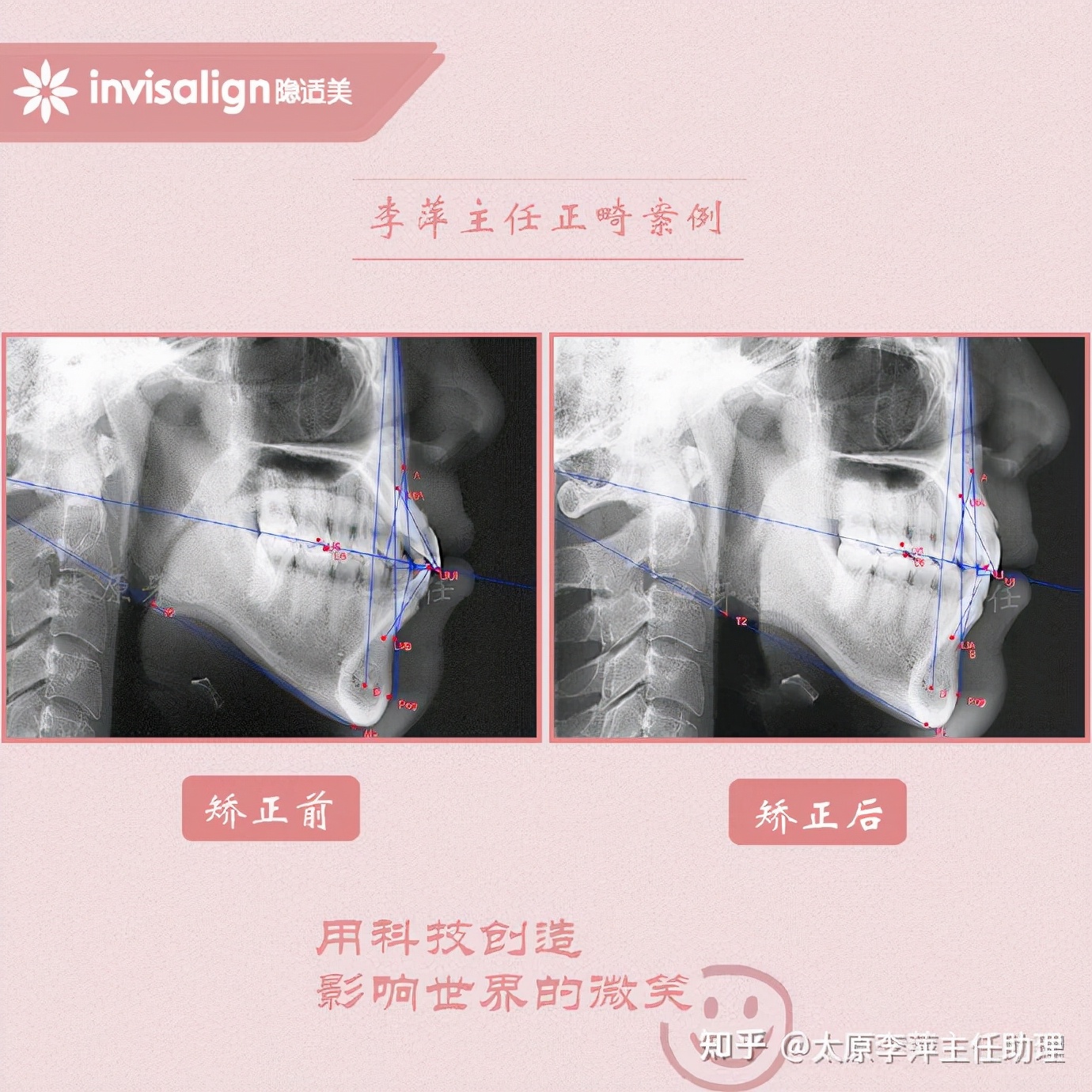 太原牙齿矫正靠谱吗,太原成人隐形牙套牙齿不齐