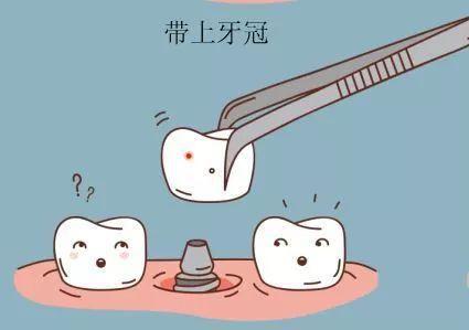 口腔种植牙护士手术配台流程,种植牙的临时冠操作流程