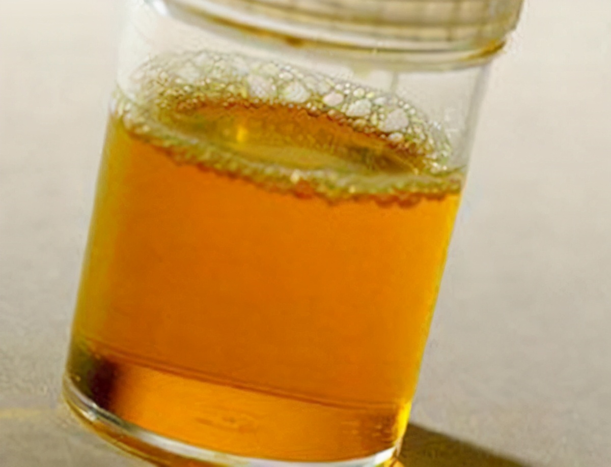 男子肾结石,男子无尿竟然是肾衰竭