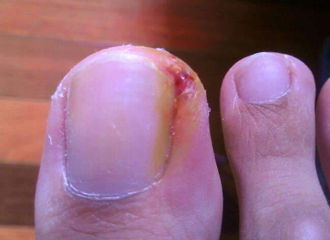 甲沟炎怎么初期治疗才能彻底根除,甲沟炎患者有多痛苦