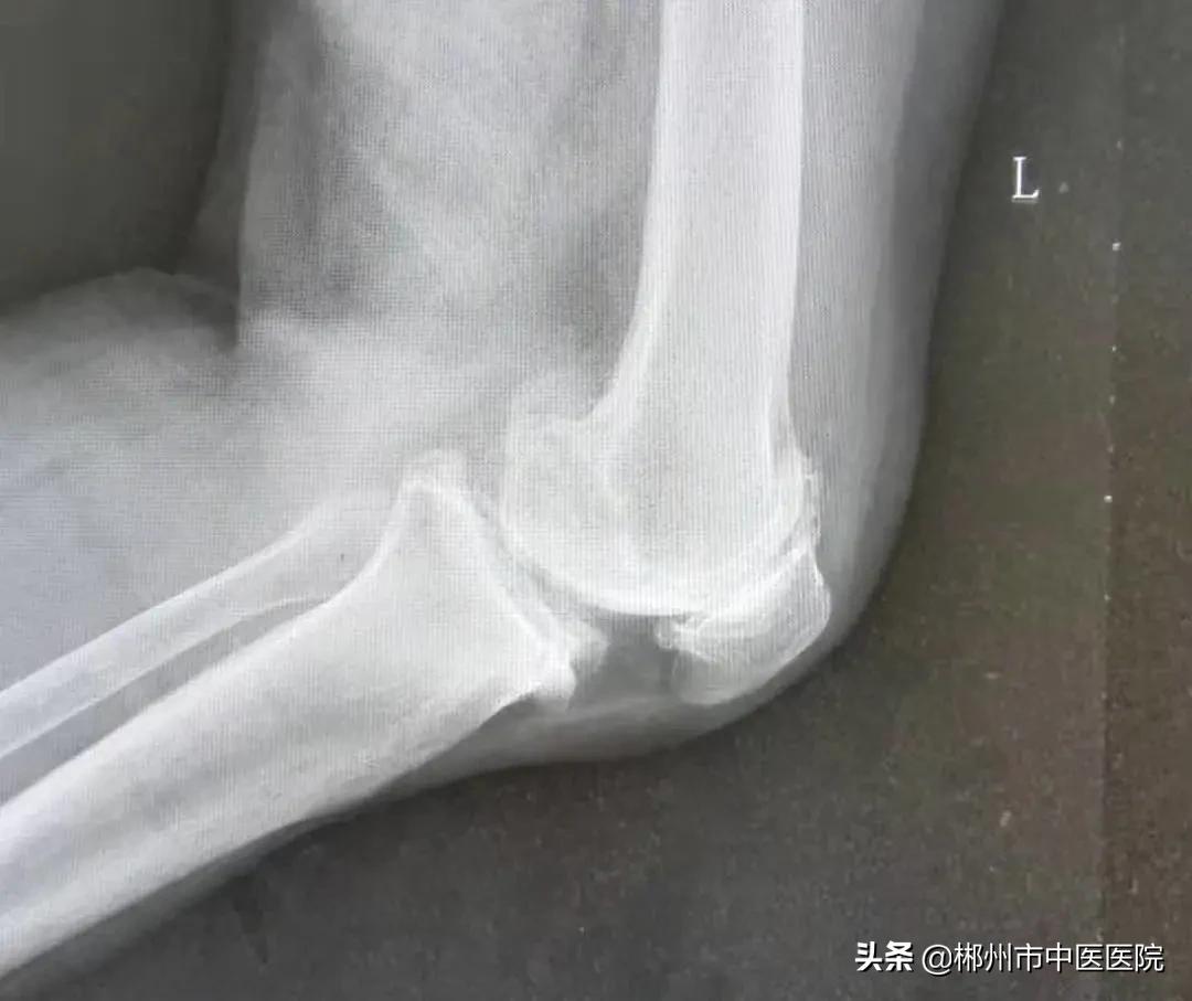 专家支招骨关节炎治疗,膝关节骨性关节炎疼痛怎么治疗